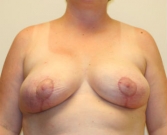 Feel Beautiful - Breast Reduction San Diego 16 - After Photo